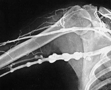 Rtg snímek ramenního kloubu Kontrastní vyšetření žil v okolí ramenního