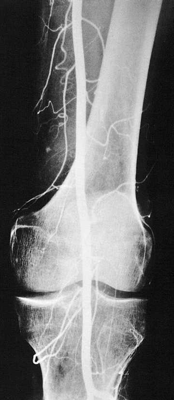 Rtg snímek kolena Arteriogram kolenního kloubu s použitím roztoku I. A.femoralis.