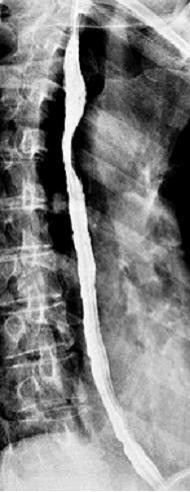 Snímek hrudníku Oesophagografie = kontrastní zobrazení jícnu při použití síranu barnatého BaSO.