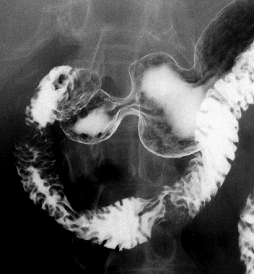 Rtg snímek břicha = gastrografie Kontrastní vyšetření žaludku za použití síranu