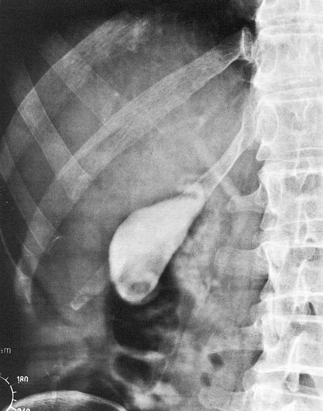 Rtg snímek břicha Kontrastní vyšetření žlučníku = cholecystografie S použitím roztoku jodového preparátu (intravenózně nebo