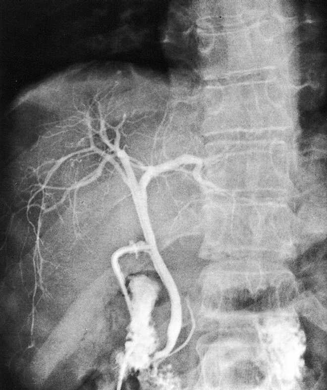 Rtg snímek břicha Kontrastní vyšetření žlučových cest během operace = cholangiogram při použití roztoku I.