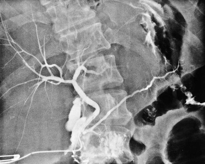 Rtg snímek břicha Kontrastní vyšetření žlučových cest během operace = cholangiogram, při použití roztoku I.