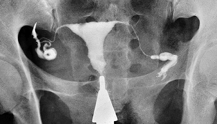 Rtg snímek pánve ženy Kontrastní vyšetření dutiny děložní a vejcovodů s pomocí I.