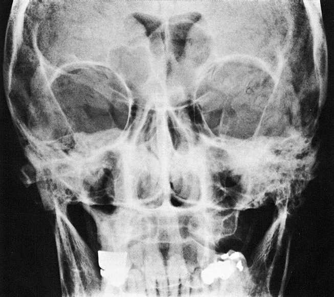 Rtg snímek hlavy předozadní projekce Pneumoencephalografie, negativní kontrastní vyšetření mozkových komor.