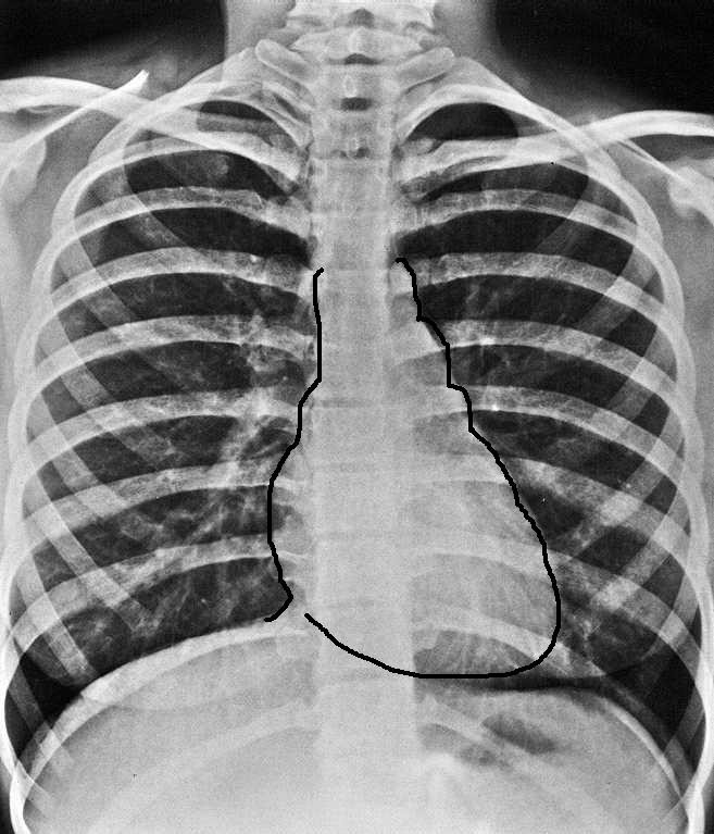 Snímek hrudníku = snímek plic Zachycuje stín srdeční a projasnění plicního parenchymu Prostý snímek Okraje srdečního stínu:. V.brachiocephalica dextra 6. V.cava sup.