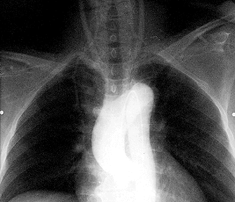 Snímek hrudníku Kontrastní zobrazení větví oblouku aorty při použití I. bulbus aortae. arcus aortae 7 6.