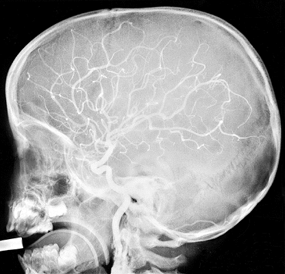 RTG snímek hlavy dítěte v boční projekci Angiografie = kontrastní vyšetření mozkových cév pomocí roztoku I