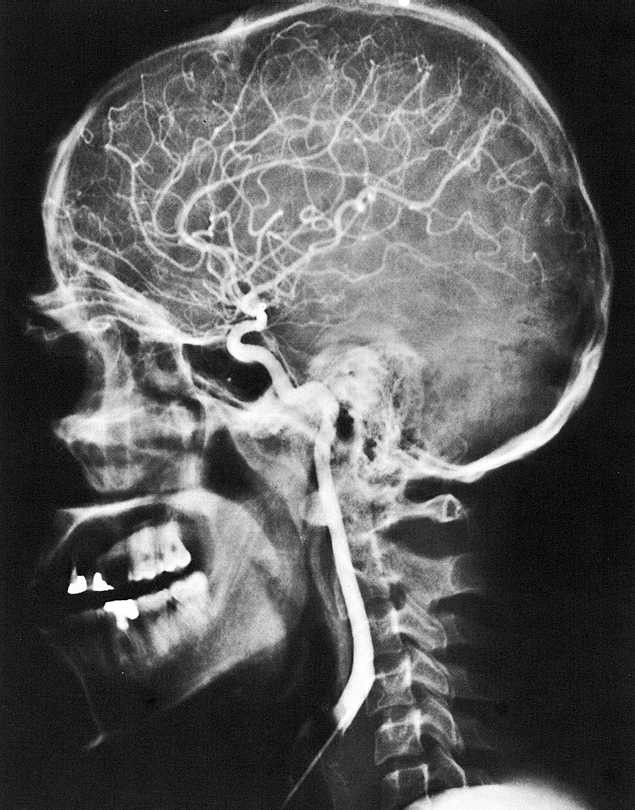RTG snímek hlavy v boční projekci Angiografie = kontrastní vyšetření mozkových cév pomocí roztoku I