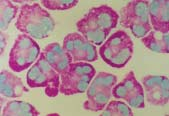 schéma, které umožòuje pøesnou formulaci cytologických nálezù urèením cytologického likvorového syndromu, což ve vìtšinì pøípadù umožòuje pøesné urèení diagnózy vyšetøovaných pacientù.