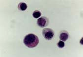 pleiocytózu (1,7).
