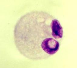 Okraj cytoplazmy bývá místy jakoby vykousnutý. Obr. 4: Monocyt (Adam P., a kol.: Cytologie mozkomíšního moku, 2 000) Aktivované monocyty (viz. obr.