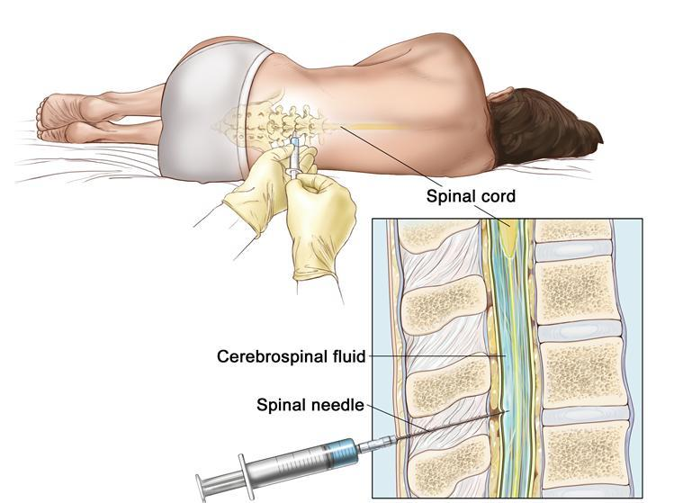 spinální mícha mozkomíšní mok jehla Obr. 2: Provedení lumbální punkce (dostupné z: http://www.cancer.gov/templates/ db_alpha.aspx?cdrid) 2.