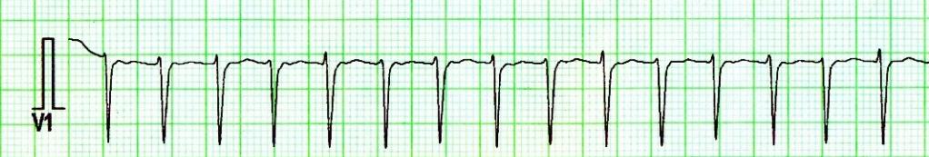 Určení srdeční frekvence: - R-R 1,5