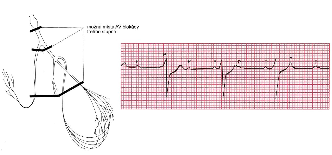 Lokalizace blokády může být v AV uzlu, v Hisově svazku nebo obou Tawarových raméncích současně, což je také vidět na obr. 18.