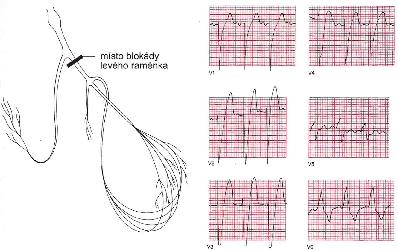 Blokáda levého Tawarova raménka Blokáda levého Tawarova raménka (LBBB) je vždy ukazatelem závažného srdečního onemocnění, nejčastěji ischemické choroby srdeční, aortální stenózy nebo dilatované