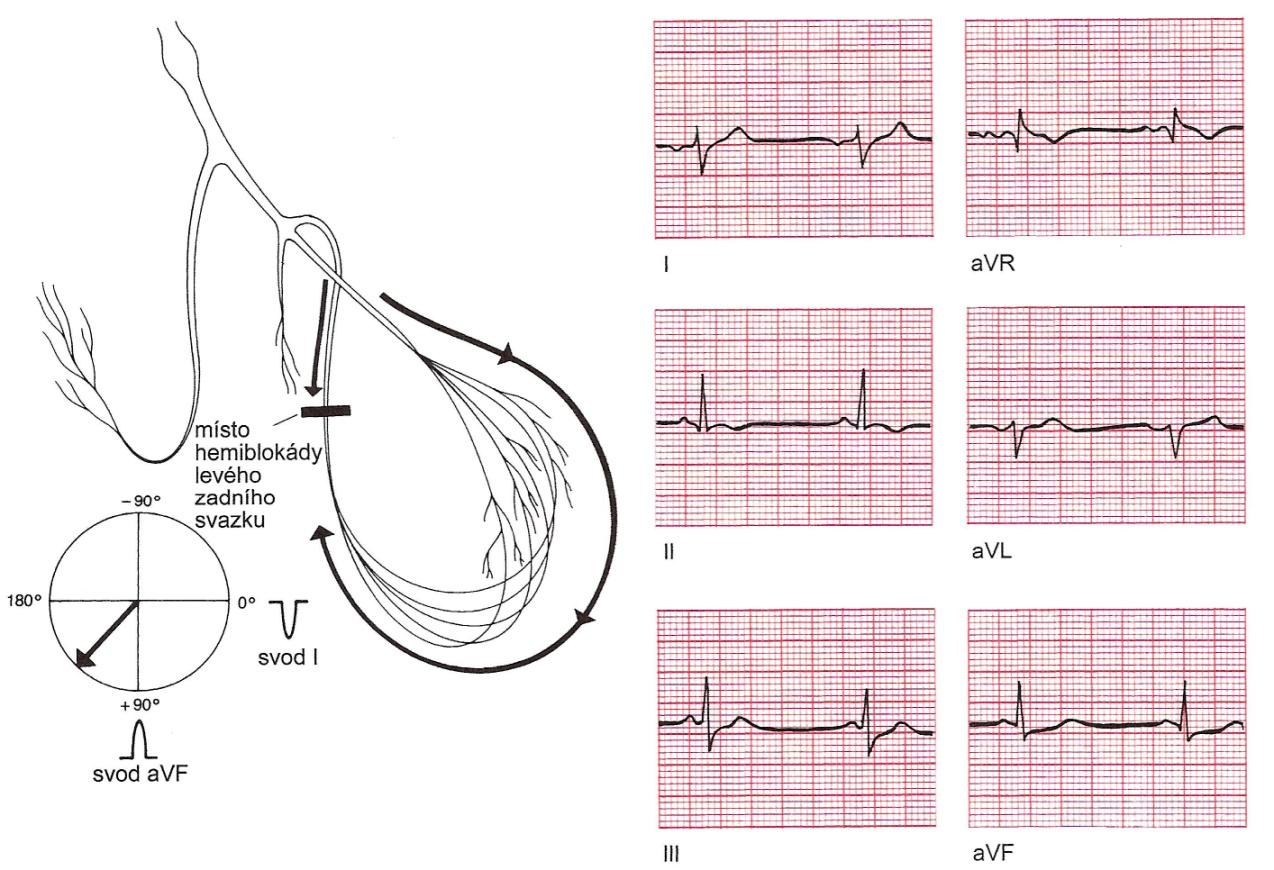 Hemiblokáda levého zadního svazku Při blokádě zadního svazku dochází k přesně opačné situaci.