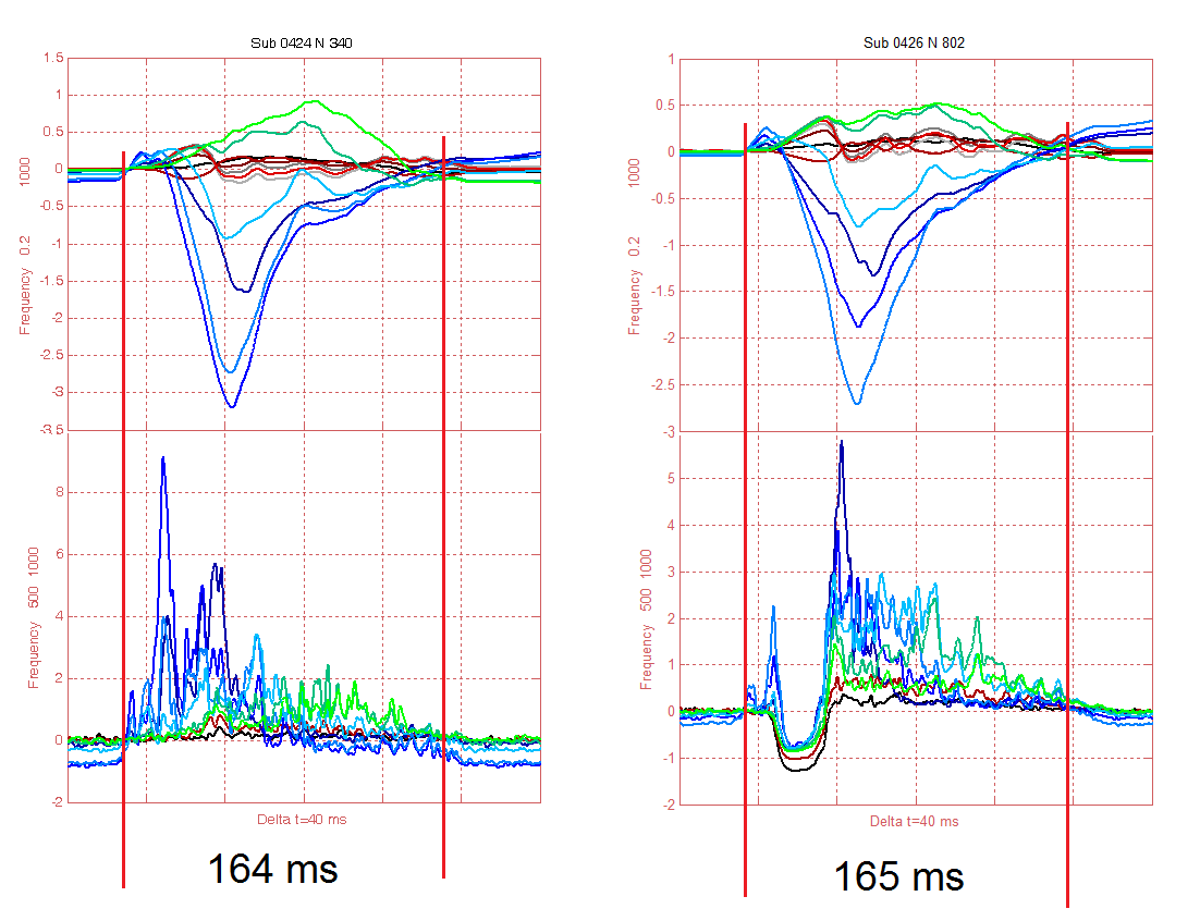 Obr. 29 UHF-QRS a amplitudové