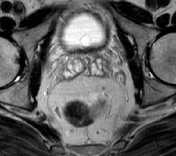 Rectum - mesorectum Anatomie peritoneum obaluje rektum na přechodu z esovité kličky, někdy tvoří krátkou výchlipku - mesorectum