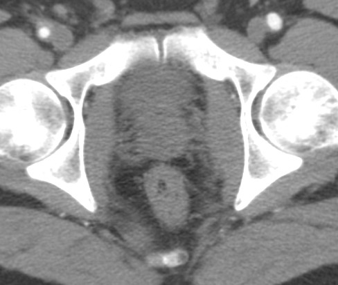 a jejich aponeurózy zadní stěna m. iliacus, m.
