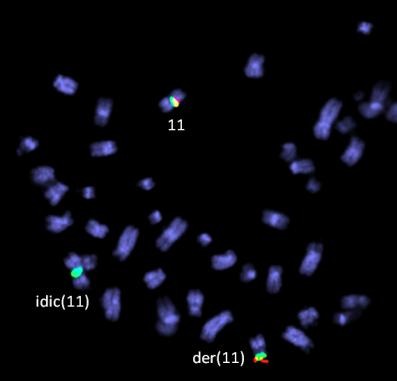 1),del(15)(q24),der(18)del(18)(p11.
