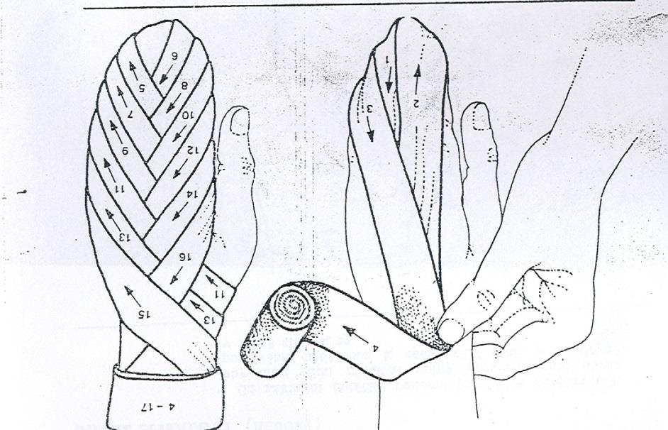 Klasový obvaz celé ruky (palec volný) obvaz vedeme středem dlaně od zápěstí (přes špičky prstů) na hřbet ruky až k zápěstí druhá a třetí obtáčka vedou
