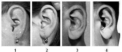 Znak 4: Reliéf ušního boltce Reliéf ušního boltce vyjadřuje celkový stupeň modelace daný stupněm vyvinutí jednotlivých chrupavčitých útvarů boltce.
