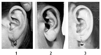 Škála znaku 22 Tvar incisura intertragica Incisura intertragica ve tvaru písmen V (1), ve tvaru písmene U (2), široce zející (3) Znak 23: Stupeň vytvoření ušního lalůčku Lalůček představuje na uchu
