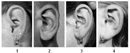 Škála znaku 23 Stupeň vytvoření ušního lalůčku Zleva doprava je patrné relativní prodlužování ušního lalůčku vzhledem k fyziognomické délce boltce Znak 24: Úhel úponu ušního lalůčku Úhel úponu ušního