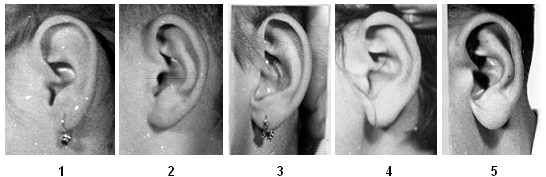 pohlavní dimorfismus v přirůstání ušního lalůčku statisticky průkazný. V přirůstání ušního lalůčku byla zjištěna individuální stranová asymetrie (5%) (Šťouračová 1992, s. 36).