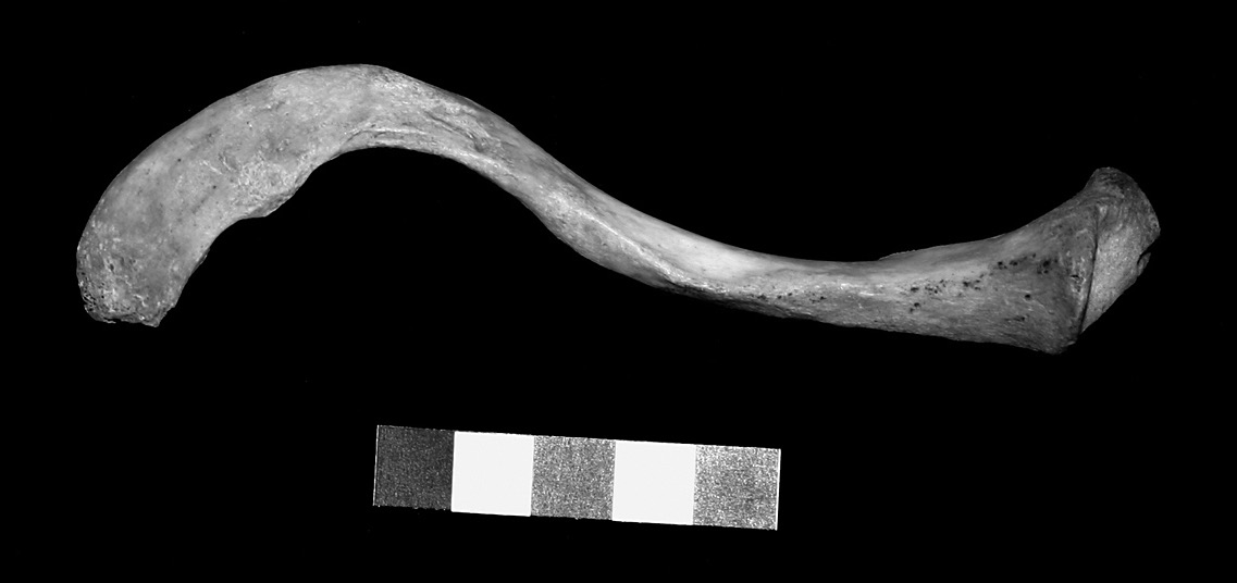 trojúhelníkovitá vkleslina, částečně potažená kloubní plochou, pod kloubní plochou je vkleslina hloubky cca 7 mm a šířky 25 mm); B RTG snímek pravé horní končetiny, na ploše
