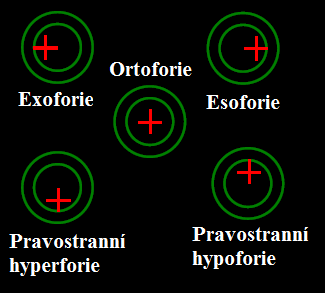 Posunutí červených světel dolů znamená hypertropii nebo hyperfórii pravého oka. Naopak nahoru značí hypotropii nebo hypofórii pravého oka.