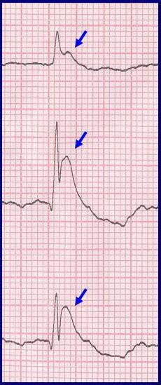 Thermogenesis. Nursingcrib [online]. 2011 [cit. 2012-02-07].