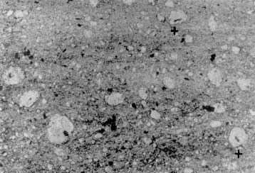columnals: oblique section of a big columnal of the crinoid genus Myelodactylus (in the centre). Fig. 5.