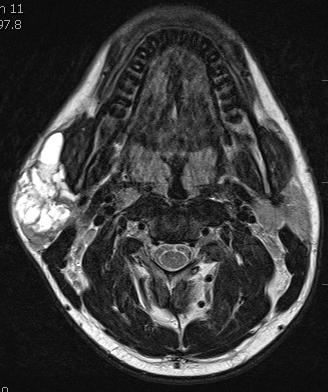 92 %) v rozlišení benigních nádorů slinných žláz od maligních (65). Obr. 2.3 Koronální řez MRI (T2 vážený obraz).