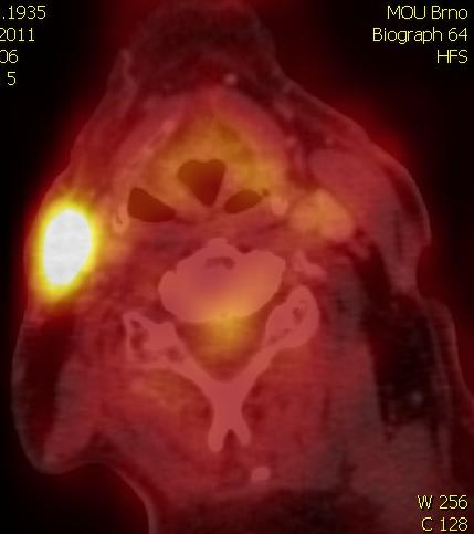2.1.6 Pozitronová emisní tomografie Pozitronová emisní tomografie (PET) je metodou hodnotící metabolickou aktivitu buněk pomocí rozložení radioaktivně značené glukózy (18F-FDG) v tkáních.