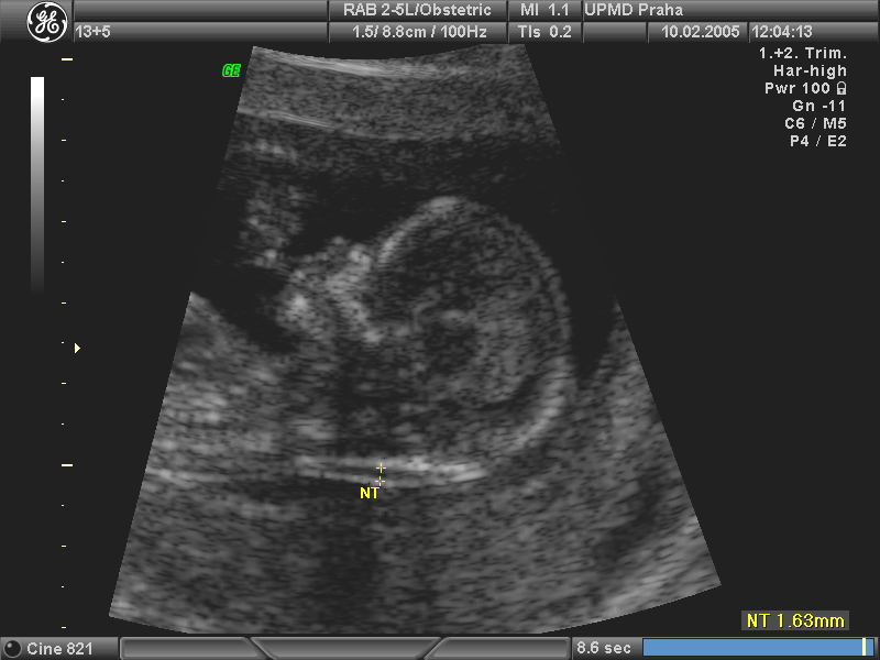 Měření NT i u vícečetného těhotenství. NT diskrepance u monochoriálních dvojčat možná časná známka feto-fetálního TRF sy.