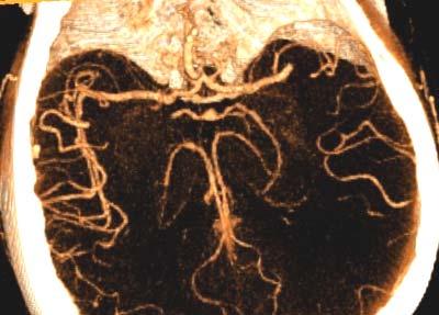 levostranná hemianopsie - NIHSS 14 CT mozku