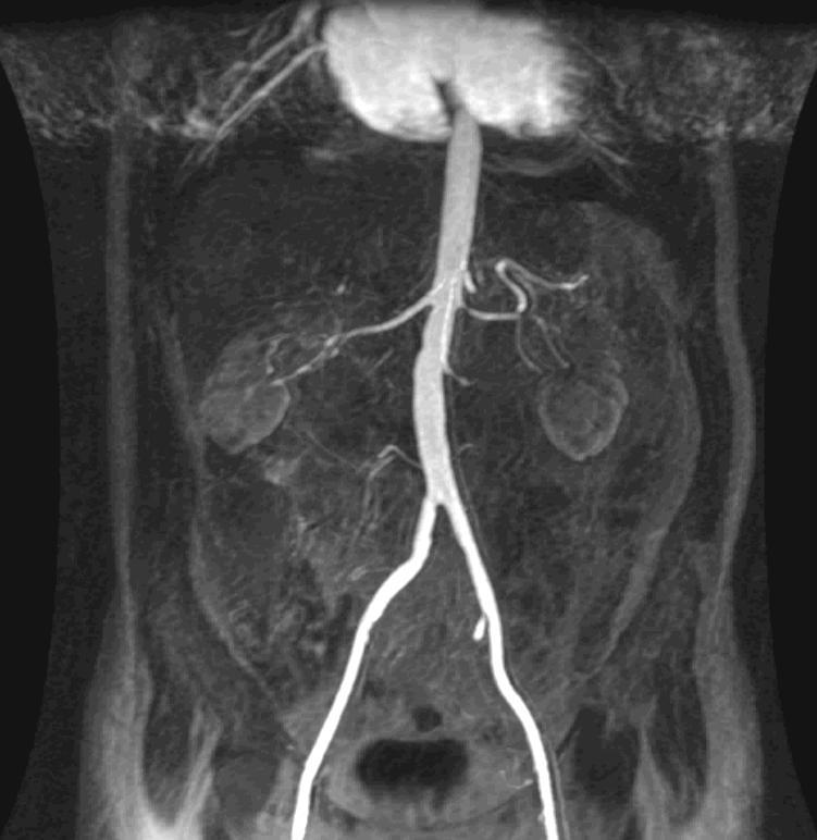 CE MRA s použitím kontrastní látky. Břišní aorta je volně průchodná, normálního kalibru.