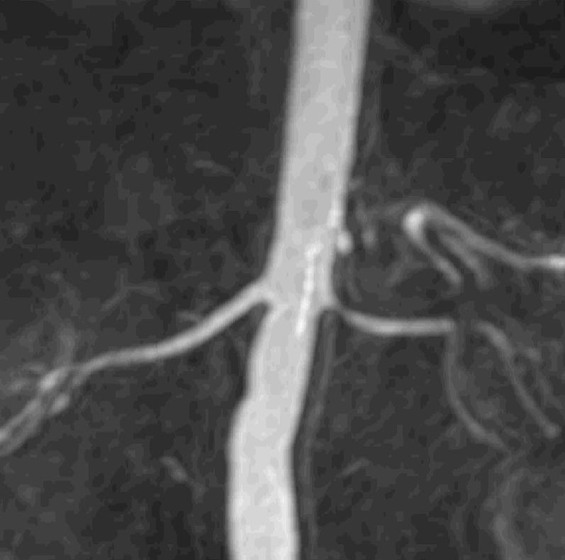 Obrázek 29 CE MRA břišní aorty stenóza levé renální tepny (zdroj: RDG centrum, Rychnov n.