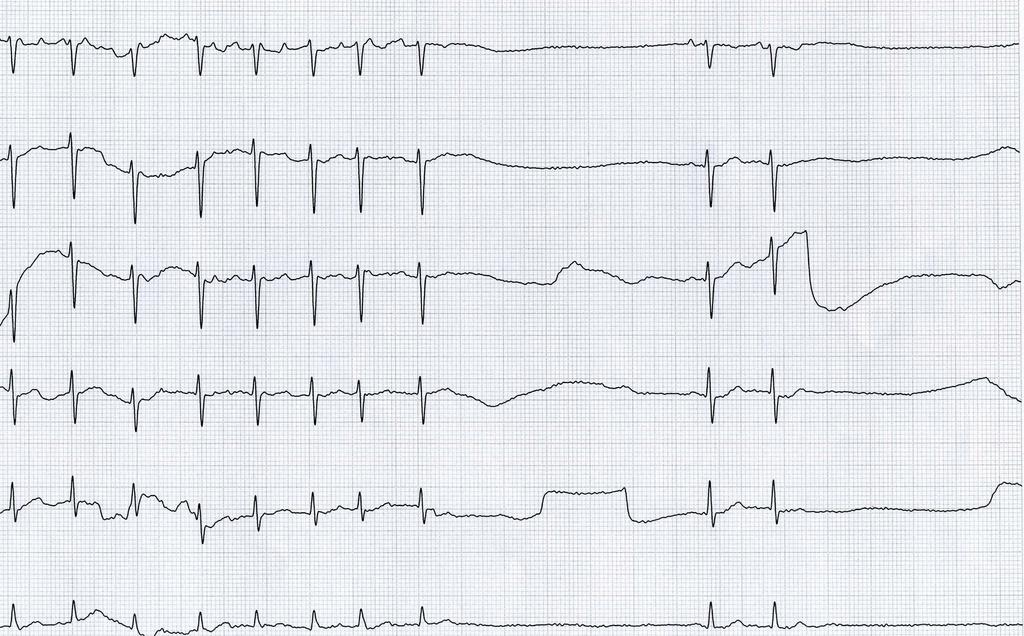 Elektronické srdce a plíce popisuje v deníčku nejprve palpitace, po kterých se dostavují prekolapsové pocity, po kterém palpitace končí. EKG 1: 4.