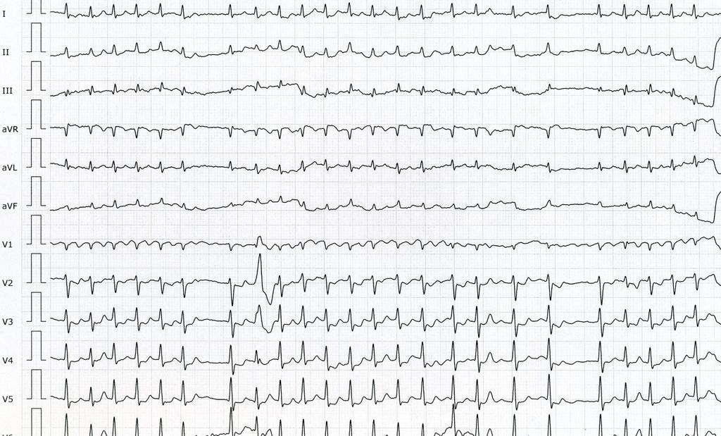 Elektronické srdce a plíce Otázka č. 4: Co je to Holterovská monitorace EKG? Otázka č. 5: Jak byste popsali arytmii na záznamu z Holterovské monitorace EKG? Otázka č. 6: Jak byste popsali EKG z koronární jednotky?