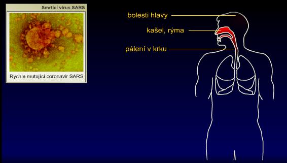 SARS: Nemoc začíná jako obyčejná rýma, chřipka či