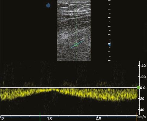 triplexní zobrazení třemi ultrazvukovými módy (B mód + CFM + PW doppler) 1.1.4.