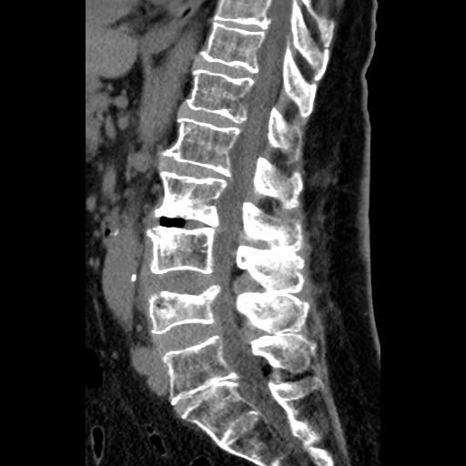 Obrázek 21 Pacient 1 - CT vyšetření