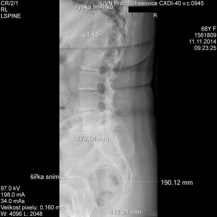 Obrázek 24 Pacient 3 - RTG snímek v