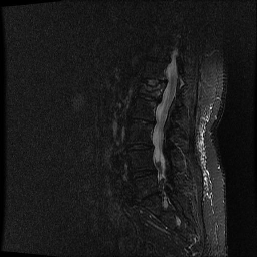 Obrázek 25 Pacient 3 - MRI STIR obraz sagitální rovina(úvn-vfn Praha, 2015) Kazuistika č.