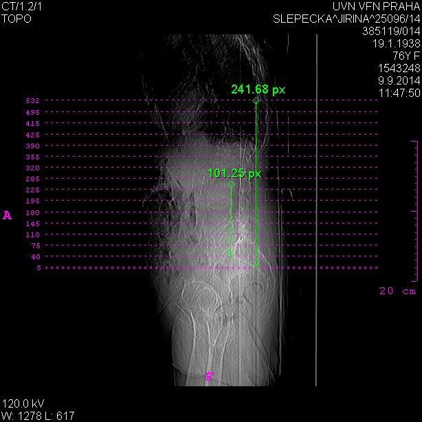 Obrázek 26 Pacient 6 CT vyšetření