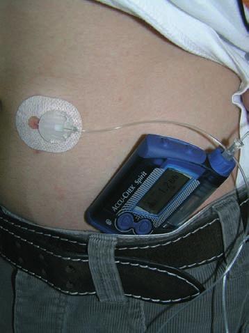 Terapie diabetes mellitus Kapitola 3. Výhody CSII podávání inzulinu Obr. 3.5 Inzulinová pumpa (foto A. Adamíková) pomocí inzulinové pumpy Vycházejí především z lepší farmakokinetiky inzulinu.