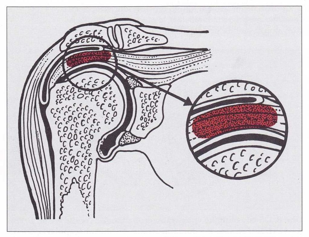 K omezení pohybu dochází především při upažování, předpažování a rotacích, kdy hlavice pažní kosti stlačuje vůči akromiu a korakoakromiálnímu vazu čepičku rotátorů a tíhový váček (Müller, 2004).